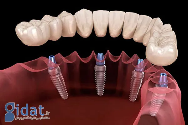 ایمپلنت فوری دندان چیست؟ + مزایا، معایب و مراحل 